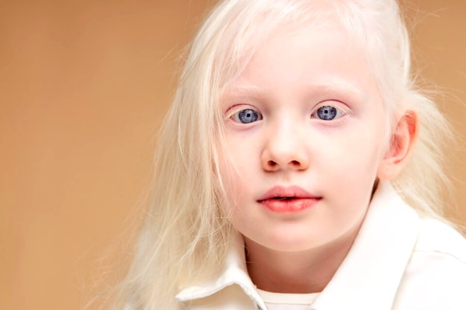 Fille albinos