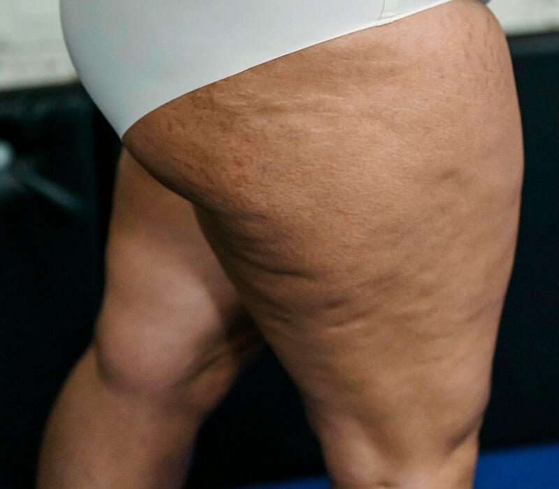 Cellulite femme enceinte